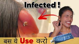 How to Heal Infected Ear Piercing Faster | 100% Result | Ravinaa Gupta