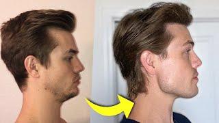 How I Fixed My Receding Chin