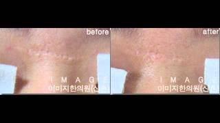 자향미한의원, 이미지한의원, 아전인수, 한방피부과전문의, 흉터침, 성형흉터, OT침, 교통사고 흉터, 흉터칼럼, 레이저부작용, 후유증, 색소침착, 착색, 화상, 피부, 진피재생