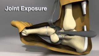 Midfoot Charcot Reconstruction Strategy