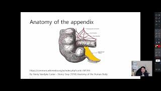 아뻬하는 법 (1/2) - 충수염 (맹장염, appendicitis) 이론 및 복강경 충수돌기절제술 (Laparoscopic appendectomy) 술기