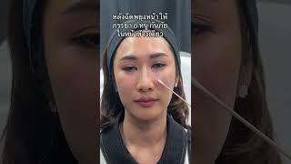 หลังฉีดฟิลเลอร์ เทคนิค #triangularfacelift ในหน้าข้างเดียว ให้ภรรยา อ หนู กันภัย ผลลัพธ์ทันที