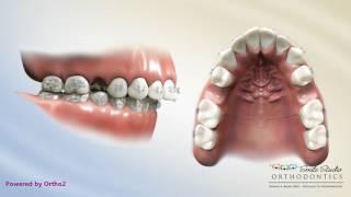 Upper 2nd Bicuspid Extraction - Overjet - Orthodontic Treatment