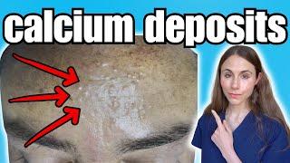 Warning Signs Of Calcium Deposits In The Skin