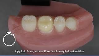 Panavia V5 work flow zirconia crown cementation