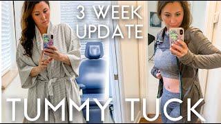 Tummy Tuck 3 Week Update | Before and After Pictures & Full Experience!