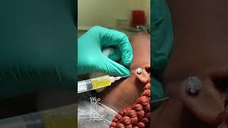 Neck Cyst Aspiration.