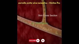 varicella zoster virus animation - What Causes Chickenpox? Best Learning Videos For Kids #shorts