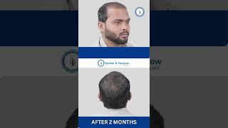 3800 Grafts Hair Transplant in Surat || Best Results & Cost of Hair Transplant in Surat Gujarat