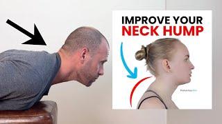 Fix Your Stubborn Neck Hump with These Simple At-Home Exercises!