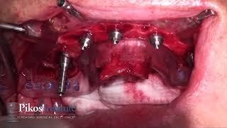 Fully Guided Full Arch All on 4 Surgical Protocol at Pikos Institute