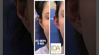 연예인들 께서 알게 모르게 하고 계신다는 필러