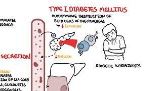 Type I and Type II Diabetes, chronic complications and management