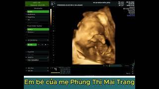 EM BÉ CỦA MẸ PHÙNG THỊ MAI TRANG - HỢP THỊNH TAM DƯƠNG VĨNH PHÚC - THAI 32 TUẦN
