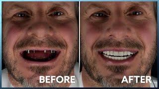 Dental Implant Success Story: How Kristal Clinic Changed his Life