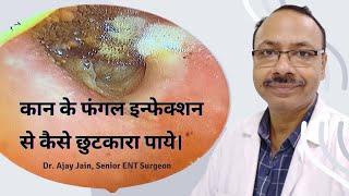 Otomycosis - कान में फंगल इन्फेक्शन के कारण व बचाव |