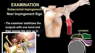 Shoulder Impingement Syndrome  - Everything You Need To Know - Dr. Nabil Ebraheim