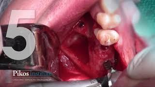 10 Step Lateral Wall One Stage Sinus Graft