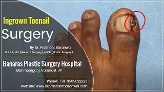 Ingrown Toenail Surgery in Varanasi | Banaras Plastic Surgery Hospital | Dr. Prashant Baranwal