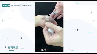 皮膚醫學 -良性腫瘤-【腱鞘囊腫】ganglion cyst