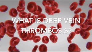 Deep vein thrombosis: A patient’s experience