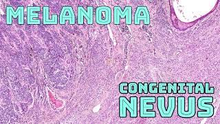 Melanoma arising in a large congenital nevus (pathology dermpath dermatology dermatopathology)