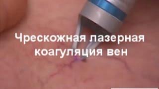 Лечение варикоза лазером в клинике УРО-ПРО | г. Ростов-на-Дону