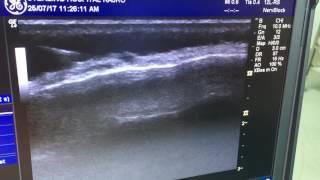 Greater Occipital Nerve Block