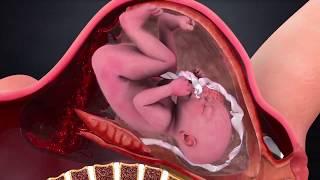 Uterine Rupture Explained by a Lawyer