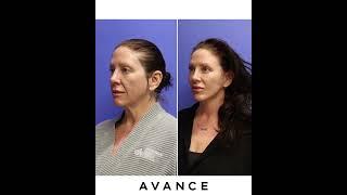 Reno NV Mini Facelift & Necklift Before & After | Dr. Erez Dayan | Avance Plastic Surgery Institute