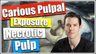 Carious Pulpal Exposure and Necrotic Pulp, William Nudera, Endodontist