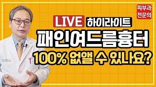 패인여드름흉터 100% 없앨 수 있나요? (여드름흉터없애는법, 여드름흉터레이저, 여드름흉터시술)