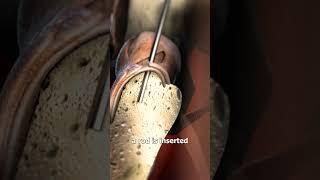 The Surgery To Become Taller 
