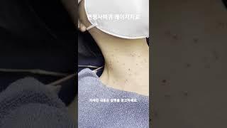 편평사마귀레이저치료 #광주피부과 #첨단사마귀치료 #더나은병원 #shorts