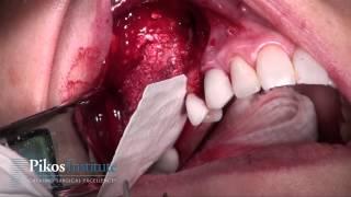 Abutment Fixation of Collagen Membrane Sinus Graft - Pikos Pearl