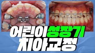 성장기(아이) 치아교정/소아교정