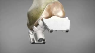 iDuo® G2 iFit® Technologie Animation