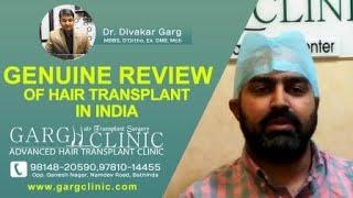 Hair Transplant Surgery: Sumit Pal Basra From Barnala by #DrDivakargarg at #garghairtransplantclinic