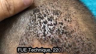 How scalp look after 10th day of Hair Transplant?