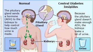 Central Diabetes Insipidus