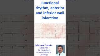 Junctional rhythm, anterior and inferior wall infarction