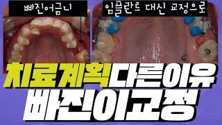 치과마다치료계획 다른이유 / 빠진 어금니 임플란트 대신 교정치료