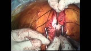 MACI Autologous Chondrocyte Implantation Surgical Video - Dr. Alan Nasar and Dr. Gregg Berkowitz