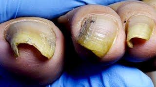 Long, Curly Toenails, Very Silky Trimmed【Pedicure Master Lin Jun】