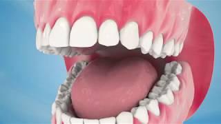 Dental Implant Procedure