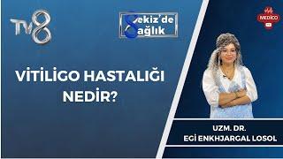 Vitiligo Hastalığı Nedir? | Uzm Dr. Egi Enkhjargal Losol | 8'de Sağlık