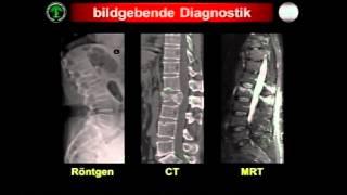 Rekonstruktion und Stabilisierung von Wirbelsäulenverletzungen