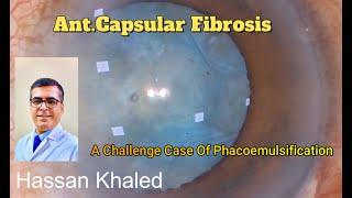 Phacoemulsification & Anterior Capsular Fibrosis