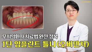 [부산전체임플란트] 무치악환자 치료법 완전 정복 1탄, 임플란트 틀니 (오버덴쳐)