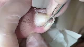 Ingrown toenail stab the toe | He Pedicure